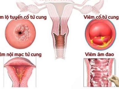 DẤU HIỆU BỆNH PHỤ KHOA DỄ NHẬN BIẾT