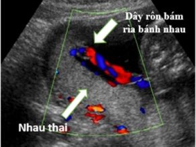 DÂY RỐN BÁM MÀNG