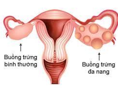 HỘI CHỨNG BUỒNG TRỨNG ĐA NANG