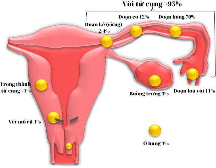 Các Vị Trí Của Thai Ngoài Tử Cung